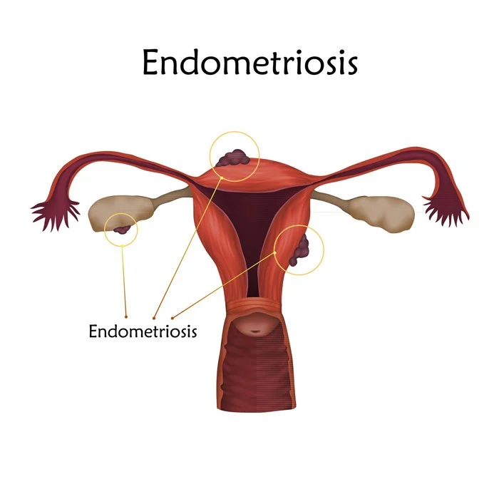 Sinais de que você pode ter endometriose como a cantora Anitta 7