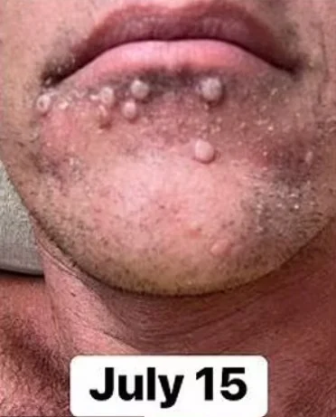 Monkeypox: saiba qual o risco de pegar doença em situações cotidianas 4