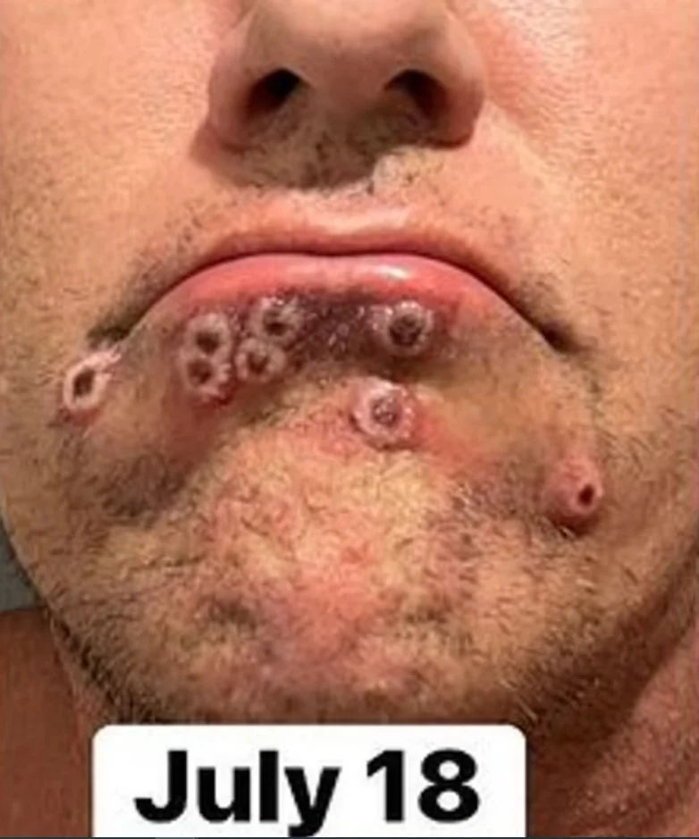 Monkeypox: saiba sobre a evolução da doença e o período de isolamento 5