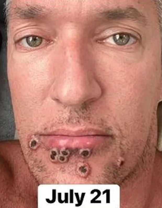 Monkeypox: saiba sobre a evolução da doença e o período de isolamento 6