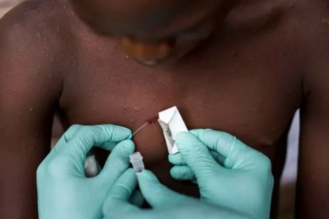 Monkeypox pode ser gatilho para convulsões, apontam cientistas 7