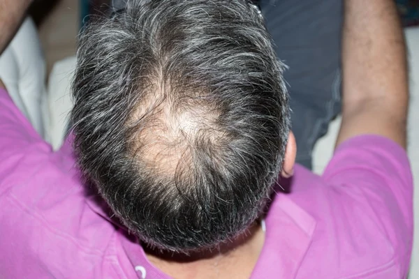 Veja 5 problemas de saúde que podem provocar queda de cabelo 6