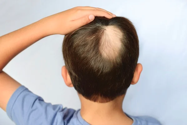 Veja 5 problemas de saúde que podem provocar queda de cabelo 10