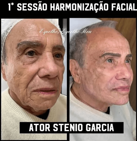 Caso Stênio Garcia: harmonização facial é contraindicada para idosos? 2