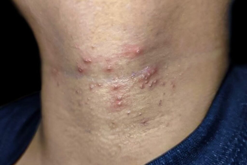 Foliculite tem solução: médico dá dicas para prevenir e tratar 2
